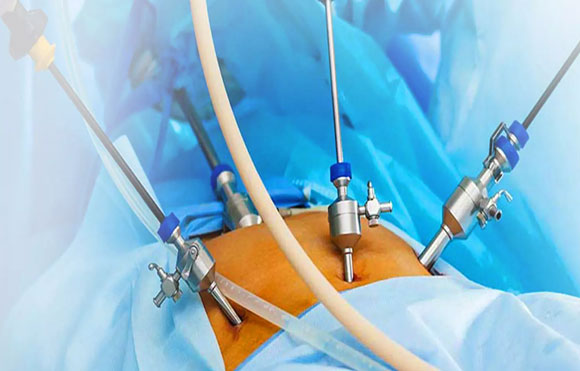 Laparoscopy