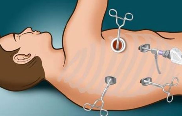 Thoracoscopy